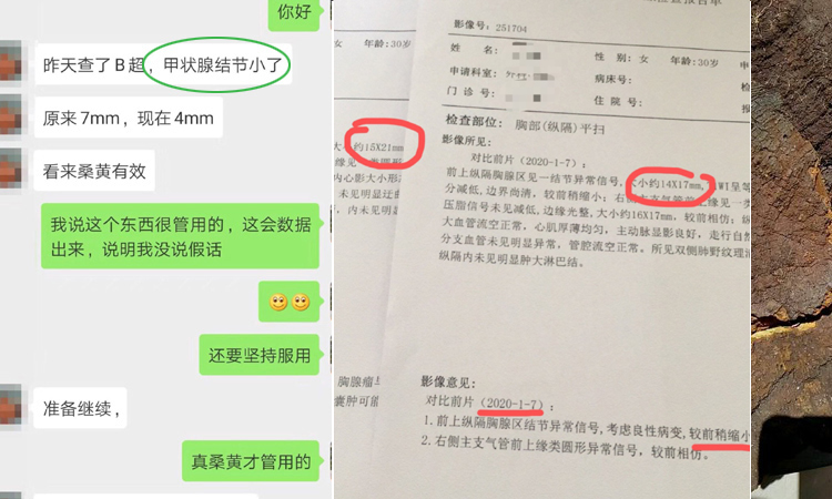 桑黃能治甲狀腺結(jié)節(jié)案例 桑黃能治甲狀腺結(jié)節(jié)案例