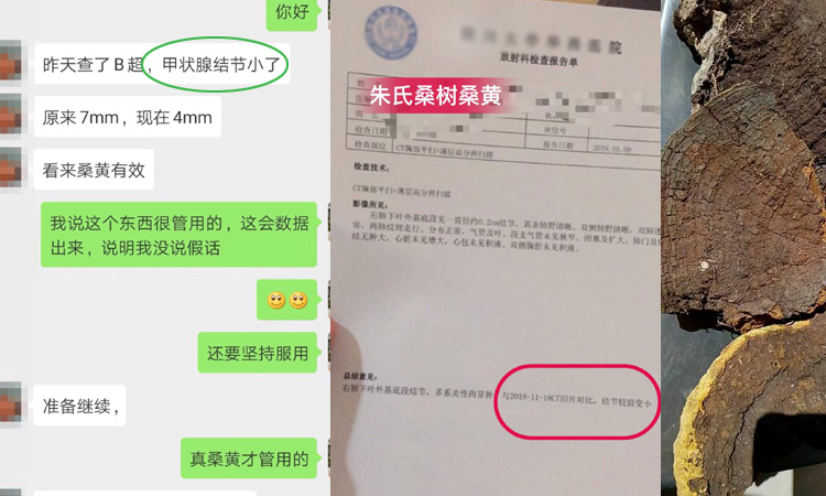 甲狀腺結(jié)節(jié)吃桑樹桑黃案例